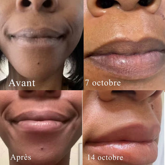 Baume ECLEA · Anti-hyperpigmentation des lèvres.